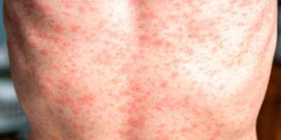 M&eacute;xico, l&iacute;der en casos de sarampi&oacute;n en el continente Americano