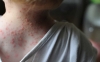 Estados Unidos reporta los primeros casos de viruela del mono en ni&ntilde;os