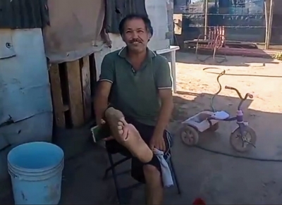 Sin trabajo por la diabetes adulto de Aguaruto en riesgo por heridas abiertas en los pies