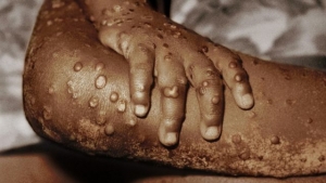 Detectan la viruela del mono en 13 pa&iacute;ses, se&ntilde;alan autoridades de salud de Europa y EEUU